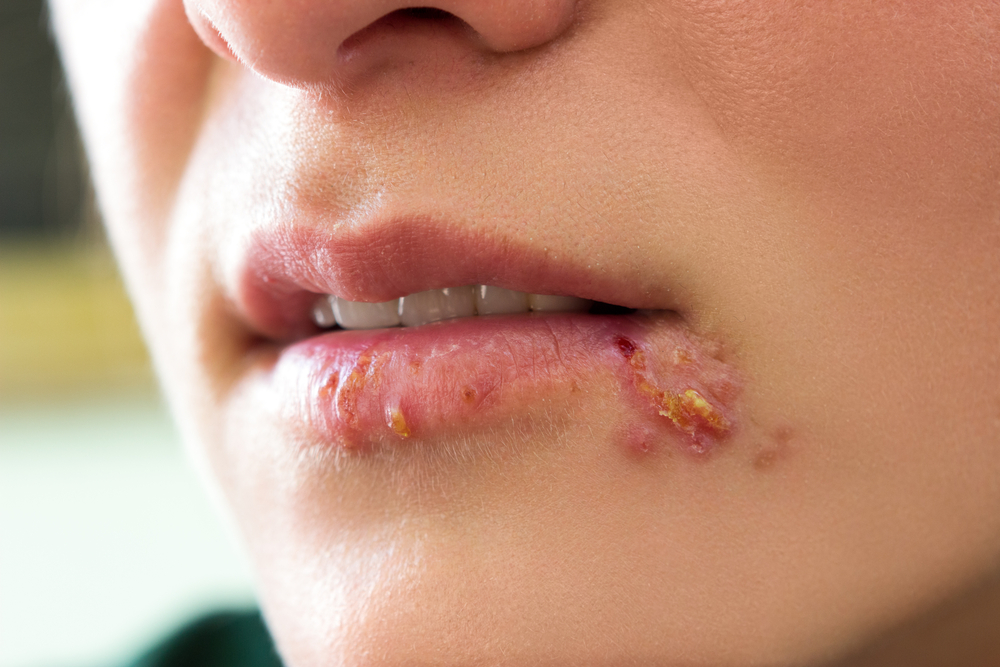 herpès buccal